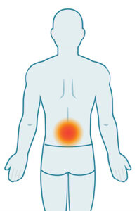 Back showing severe stage